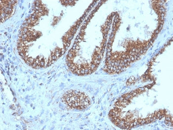 IHC staining of FFPE human prostate carcinoma tissue with recombinant TMEPA1 antibody (clone PMEPA1/