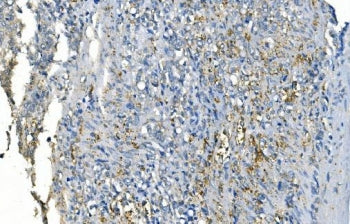 IHC staining of FFPE human gastric cancer with CA1 antibody. HIER: boil tissue sections in pH8 EDTA 