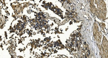 IHC staining of FFPE human bladder cancer with RGS6 antibody. HIER: boil tissue sections in pH8 EDTA
