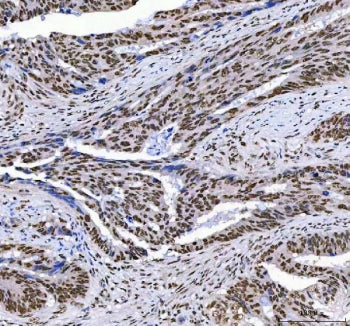 IHC staining of FFPE human colorectal adenocarcinoma tissue with Aryl Hydrocarbon Receptor Repressor