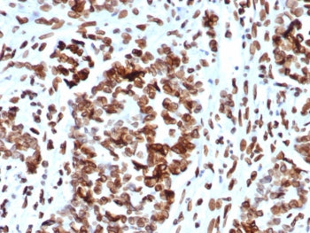 IHC staining of FFPE human ovarian cancer tissue with MDM2 antibody (clone MDM2/7942). HIER: boil ti