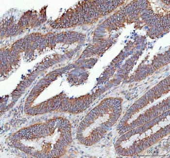 IHC staining of FFPE human colorectal adenocarcinoma tissue with SLC12A6 antibody. HIER: boil tissue