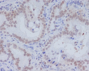 IHC staining of FFPE human colon carcinoma with CD11b antibody. HIER: boil tissue sections in pH6, 1