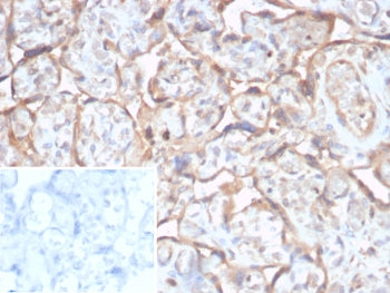 IHC staining of FFPE human prostate carcinoma tissue with TGF beta 2 antibody (clone TGFB2/1679). In