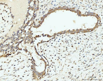 IHC staining of FFPE human breast cancer tissue with RPL29 antibody. HIER: boil tissue sections in p