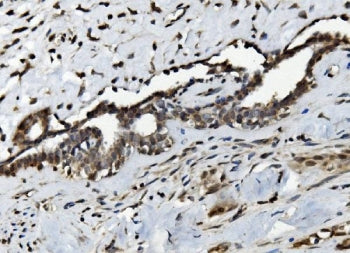IHC staining of FFPE human breast cancer with Serum Response Factor antibody. HIER: boil tissue sect