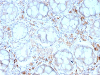 IHC staining of FFPE human colon carcinoma with recombinant CD209 antibody (clone rC209/1781). HIER: