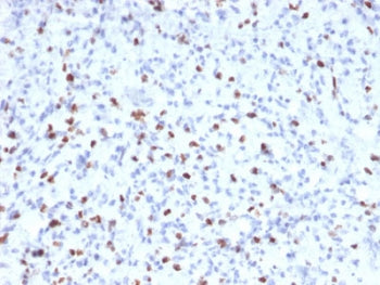IHC staining of FFPE human rhabdomyosarcoma with Myogenin antibody (clone MYOG/2660). HIER: boil tis