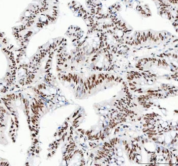 IHC staining of FFPE human rectum adenocarcinoma tissue with NUCKS1 antibody. HIER: boil tissue sect