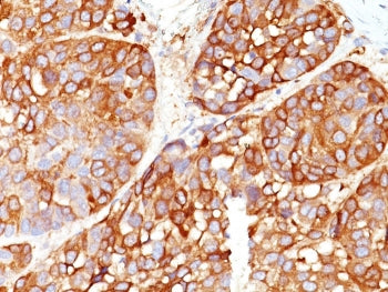IHC staining of FFPE human melanoma tissue with Melanoma Marker antibody cocktail (clones DT101+ BC1