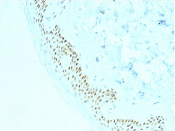 IHC testing of FFPE human basal cell carcinoma with p63 antibody (clone TP63/2428). HIER: boil tissu