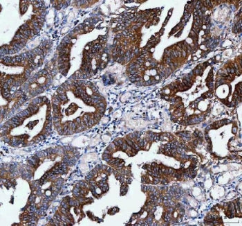 IHC staining of FFPE human colorectal adenocarcinoma tissue with IFT52 antibody. HIER: boil tissue s