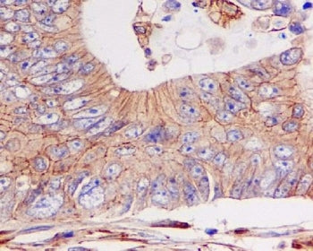 IHC staining of FFPE human colon cancer with E-Cadherin antibody. HIER: boil tissue sections in pH6,