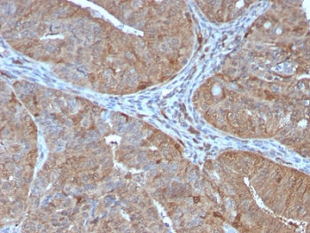 IHC testing of FFPE human prostate with AKR1B1 antibody (clone CPTC-AKR1B1-2). Required HIER: boil t
