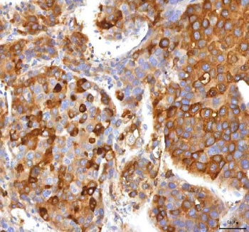 IHC staining of FFPE human liver cancer tissue with HSD17B13 antibody. HIER: boil tissue sections in