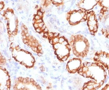 IHC testing of FFPE human renal cell carcinoma with recombinant Cadherin 16 antibody (clone KSCP2-2R