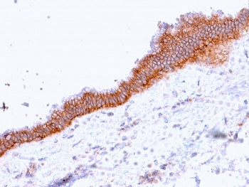 IHC staining of FFPE human pancreatic carcinoma with MRP3 antibody (clone ABCC3/2971). HIER: boil ti