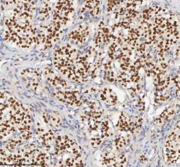 IHC staining of FFPE human lung adenocarcinoma tissue with MACROH2A1 antibody. HIER: boil tissue sec