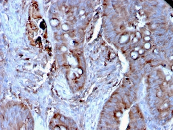 IHC staining of FFPE human colon carcinoma tissue with MERTK antibody (clone MERTK/3024). HIER: boil