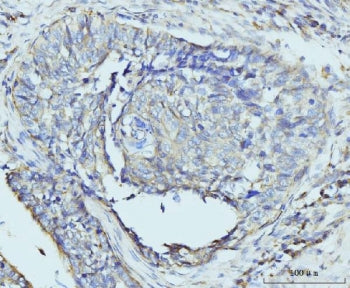 IHC staining of FFPE human lung cancer tissue with RPL23 antibody. HIER: boil tissue sections in pH8