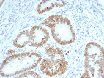 IHC staining of FFPE human colon carcinoma tissue with SATB2 antibody (clone SATB2/7110). Strong nuc