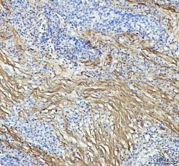 IHC staining of FFPE human lung squamous cell carcinoma tissue with Collagen I antibody. HIER: boil 