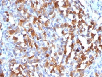 IHC testing of FFPE human melanoma stained with MART-1 antibody. HIER: steam sections in pH 9 10mM T