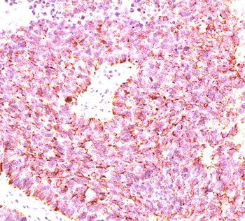 IHC testing of human small cell lung carcinoma stained with chromogranin A antibody cocktail (clones
