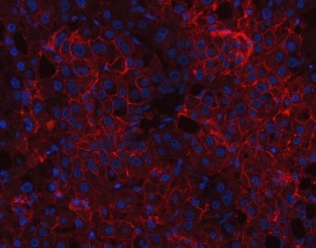 Immunofluorescent staining of FFPE human liver cancer tissue with CD166 antibody (red) and DAPI nucl