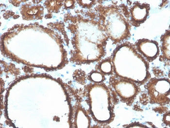 IHC staining of FFPE human thyroid carcinoma with TPO antibody. HIER: boil tissue sections in pH 9 1