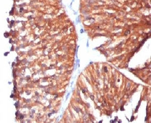 IHC testing of FFPE human bladder carcinoma and HSP60 antibody (clone SRPR60). Staining of formalin-