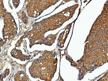 IHC staining of FFPE human breast cancer tissue with Elongation Factor 2 antibody. HIER: boil tissue