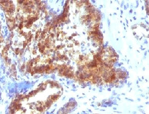 IHC: Formalin-fixed, paraffin-embedded human prostate carcinoma stained with Prostate Specific antib