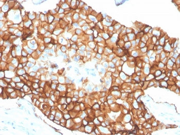 IHC staining of FFPE human breast carcinoma tissue with recombinant ErbB2 antibody (clone ERBB2/4376