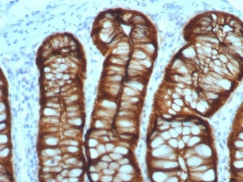 IHC staining of FFPE human colon adenocarcinoma with Villin antibody (clone VIL1/7378R). HIER: boil 
