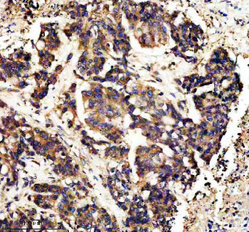 IHC staining of FFPE human colon cancer tissue with CAMK II alpha antibody, HRP-secondary and DAB su