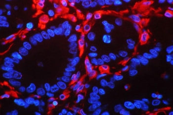 Immunofluorescent staining of FFPE human intestinal cancer with Vimentin antibody (red) and DAPI nuc