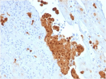 IHC testing of FFPE human mesothelioma with Calbindin 2 antibody (clone CALB2/2786). HIER: boil tiss