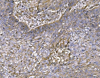 IHC staining of FFPE human lung cancer tissue with FAM129B antibody. HIER: boil tissue sections in p