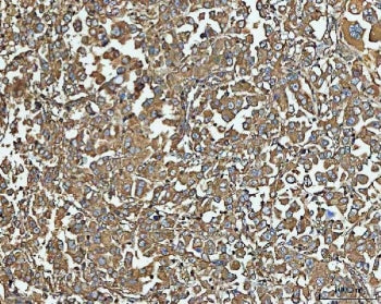 IHC staining of FFPE human lung cancer tissue with NT5C antibody. HIER: boil tissue sections in pH8 