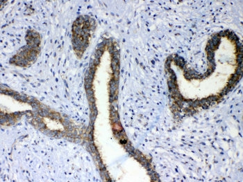 IHC testing of FFPE human breast cancer tissue with ERBB4 antibody at 1ug/ml. Required HIER: steam s