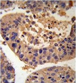 IHC testing of FFPE human hepatocarcinoma with AGXT antibody. HIER: steam section in pH6 citrate buf