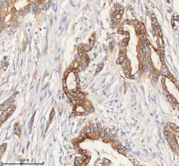 IHC staining of FFPE human pancreas ductal adenocarcinoma tissue with HER4 antibody. HIER: boil tiss