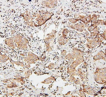 IHC staining of FFPE human breast cancer with SDHB antibody. HIER: boil tissue sections in pH6, 10mM
