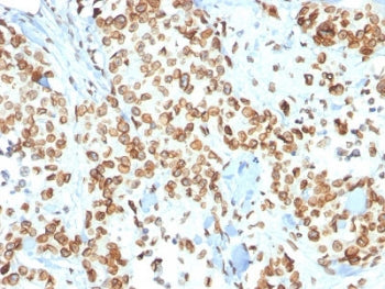 IHC testing of FFPE human breast carcinoma with Emerin antibody (clone EMD/2167). Required HIER: boi