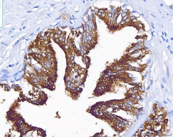 IHC staining of FFPE human prostate cancer tissue with ACP3 antibody. HIER: boil tissue sections in 