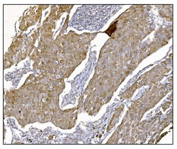 IHC staining of FFPE human breast cancer tissue with Nudel antibody. HIER: boil tissue sections in p