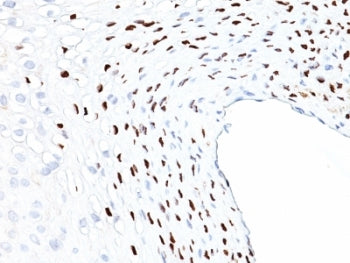 IHC: Formalin-fixed, paraffin-embedded human cervix stained with HPV-16 L1 antibody (clone HPV16L1/1