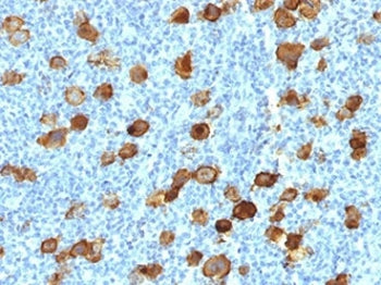 IHC testing of FFPE Hodgkin's lymphoma stained with recombinant CD30 antibody (clone Ki-1/4399R). Re