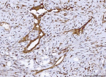 IHC staining of FFPE human breast cancer tissue with COX1 antibody. HIER: boil tissue sections in pH